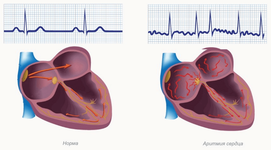 Аритмия сердца что это. Атриовентрикулярная аритмия. Гипертрофия миокарда аритмии. Нарушение ритма. Нарушения сердечного РТМ.